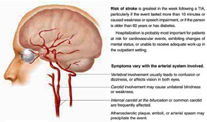Transient-Ischemic-AttackFU_300